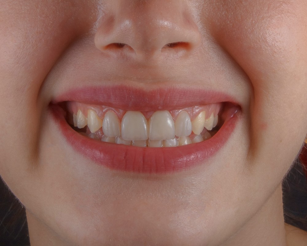 Gummy smile — Sano Dental & Aesthetic, Kragujevac