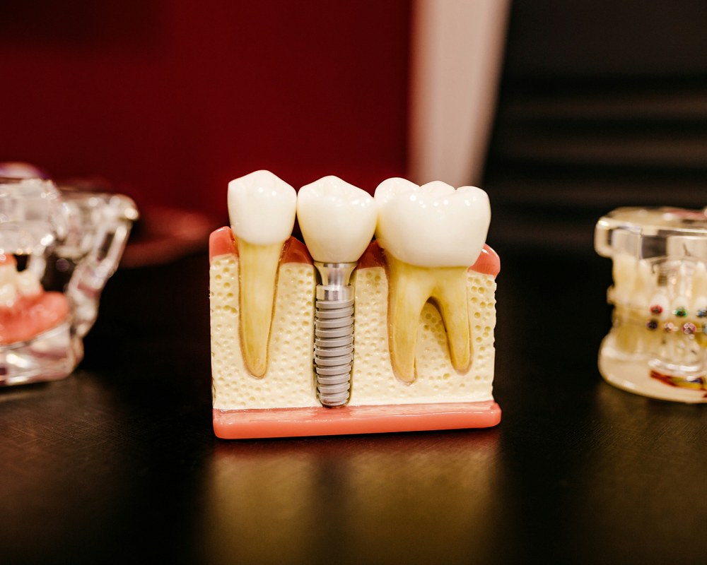 Bezmetalne navlake i mostovi — Sano Dental & Aesthetic, Kragujevac