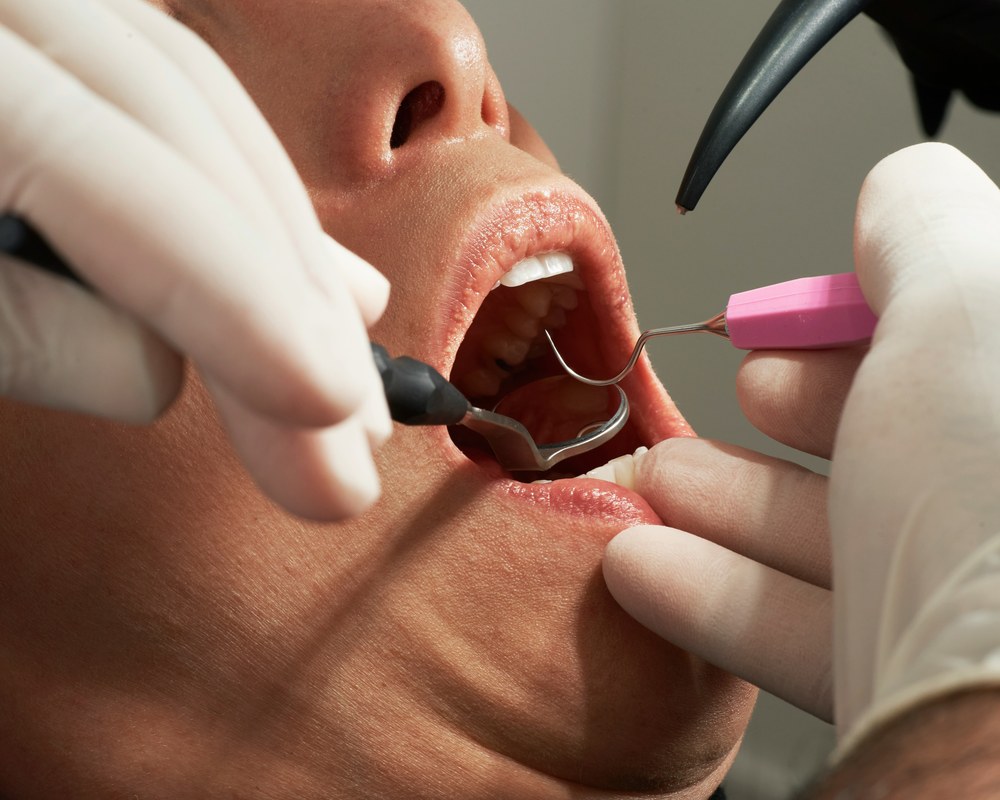 Parodontoza (parodontopatija) — Sano Dental & Aesthetic, Kragujevac