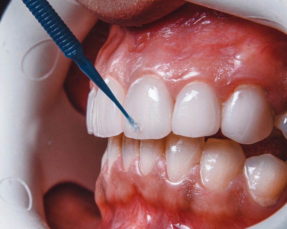 Plombe — Sano Dental & Aesthetic, Kragujevac